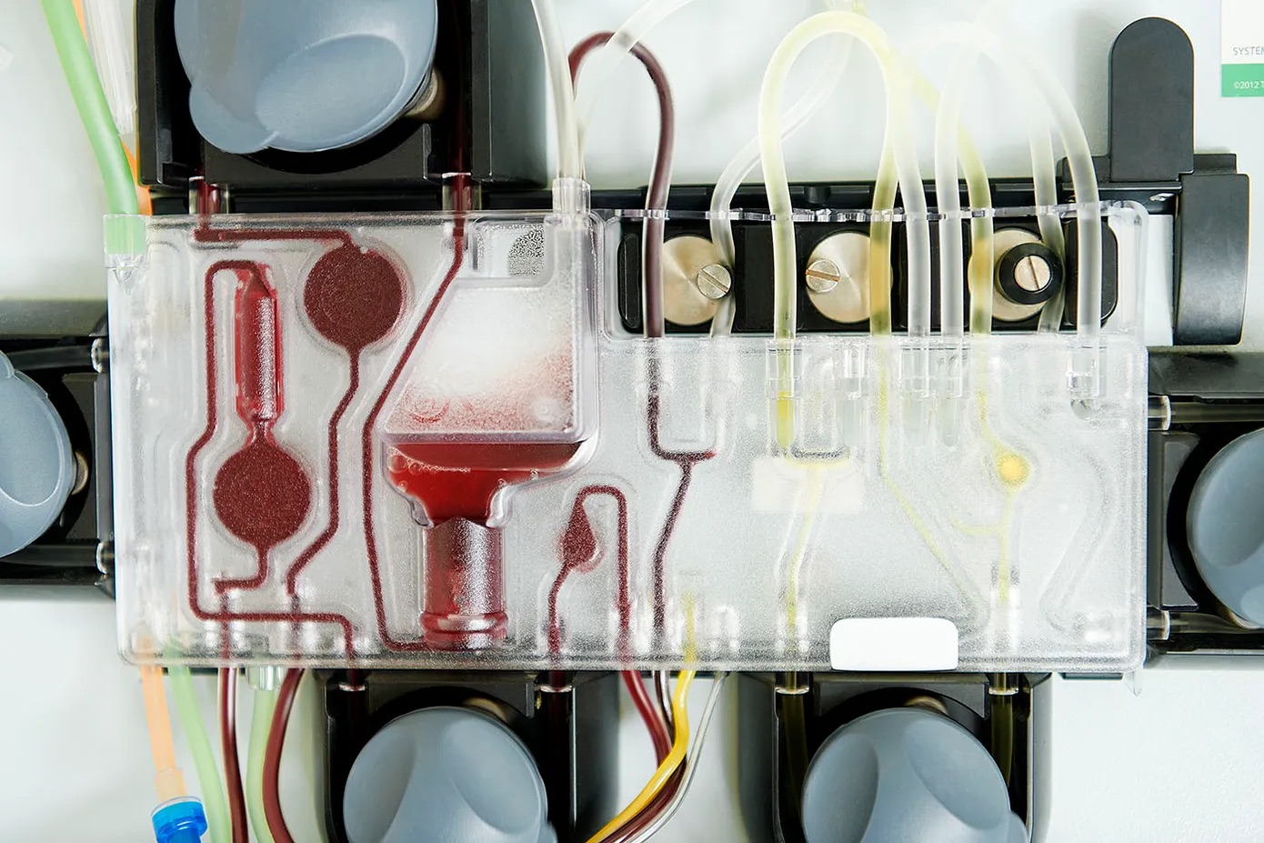 Therapeutic Plasma Exchange